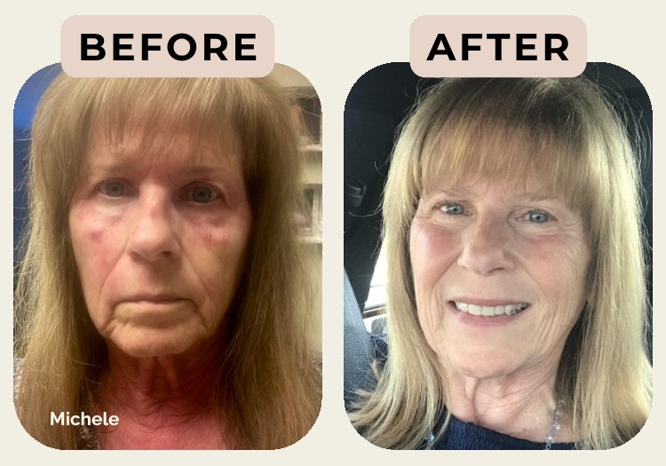 Michele — before and after