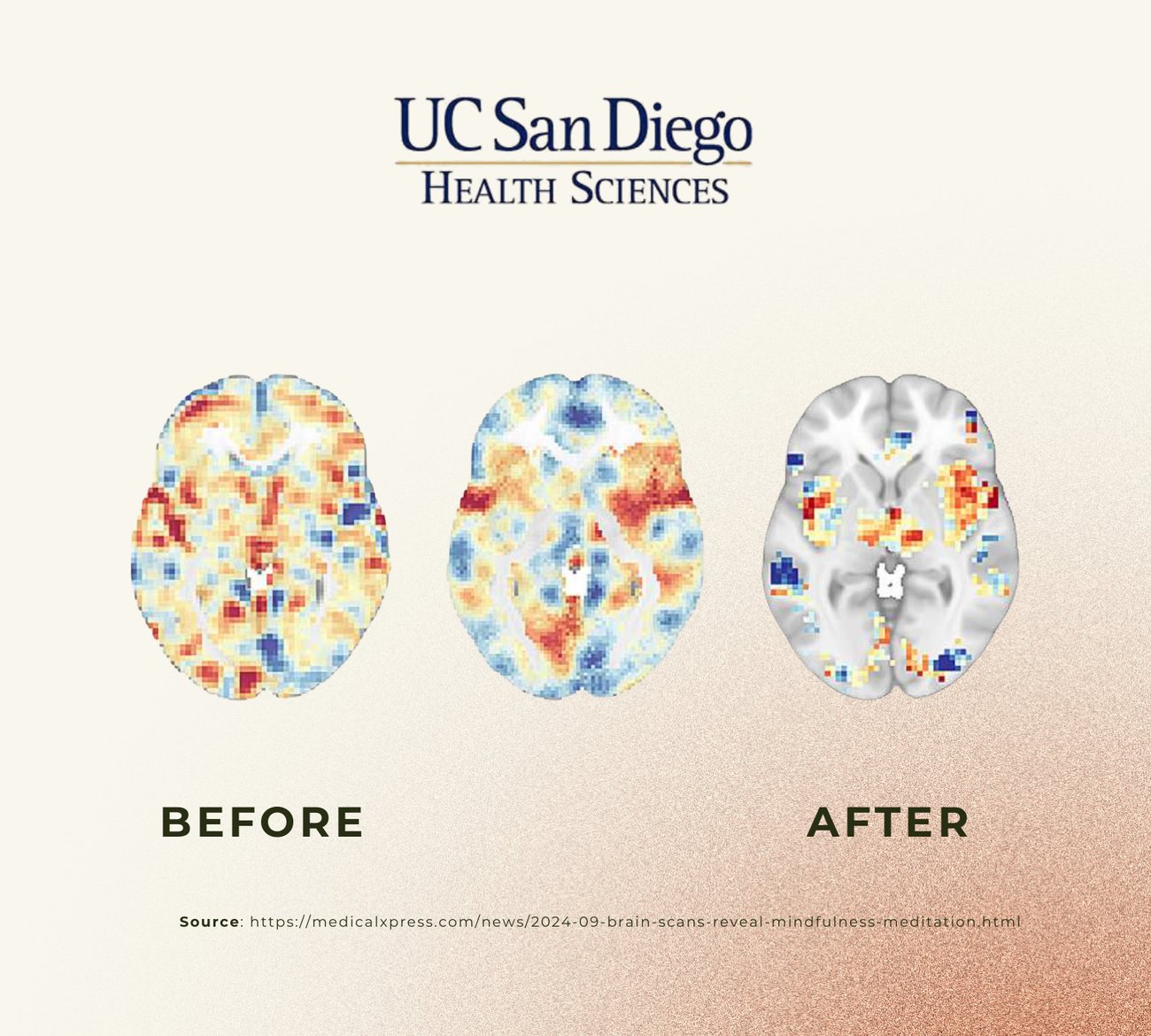 Brain scans before and after a mind-body intervention showing calmer activity