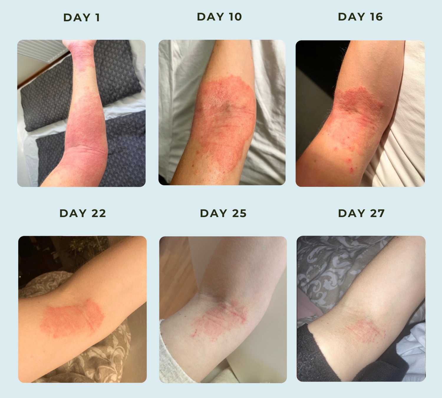 One woman's eczema clearing from Day 1 to Day 27