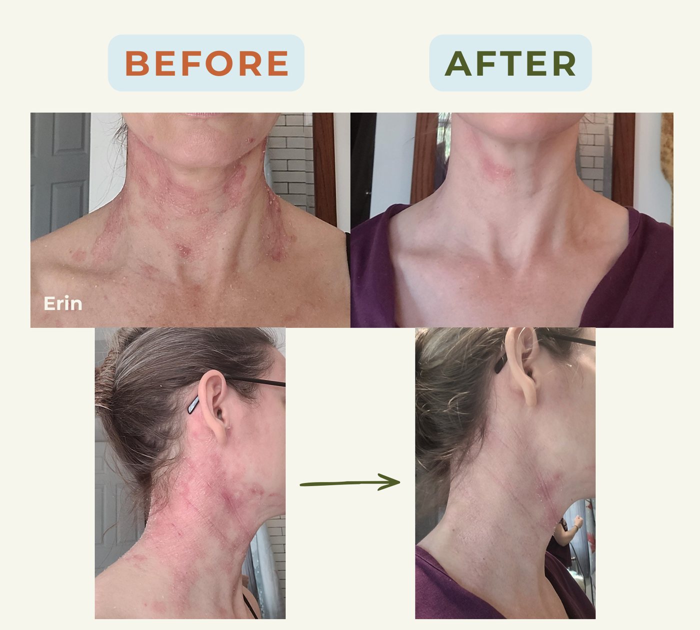 Erin, before and after — neck eczema cleared