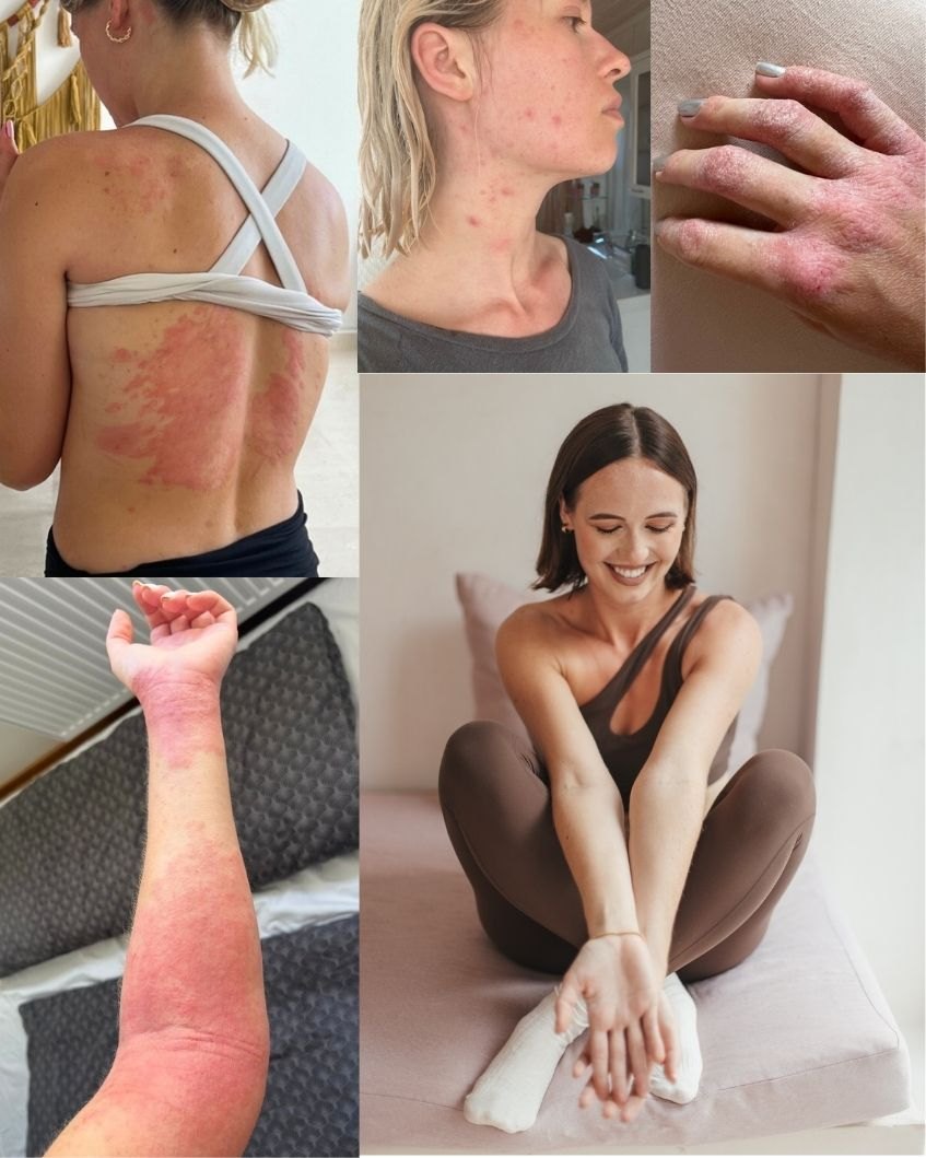 Mia Lovequest — her skin before, and after healing